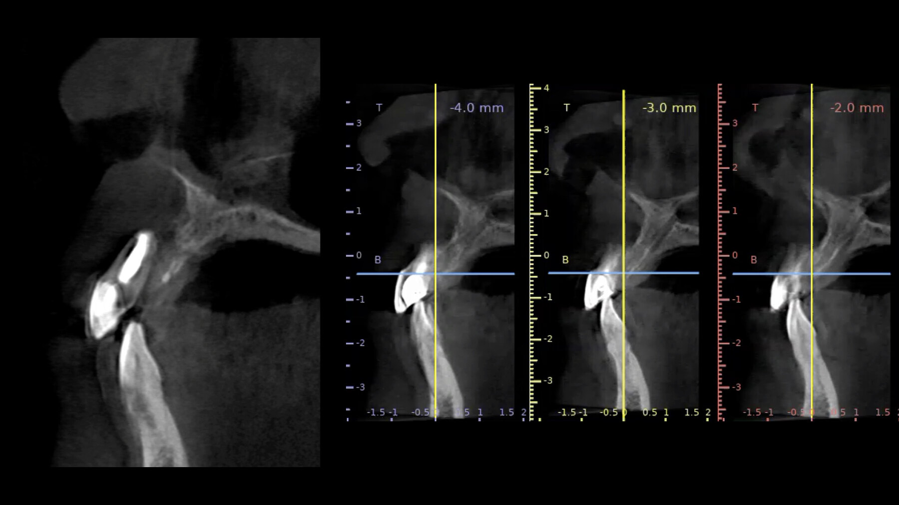 Análisis tridimensional del defecto