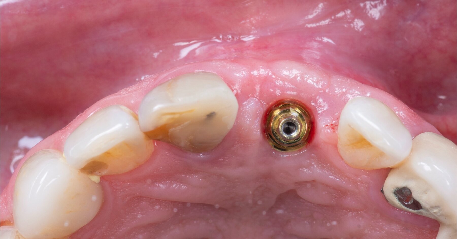 Documentación clínica de Manejo de tejidos blandos periimplantarios