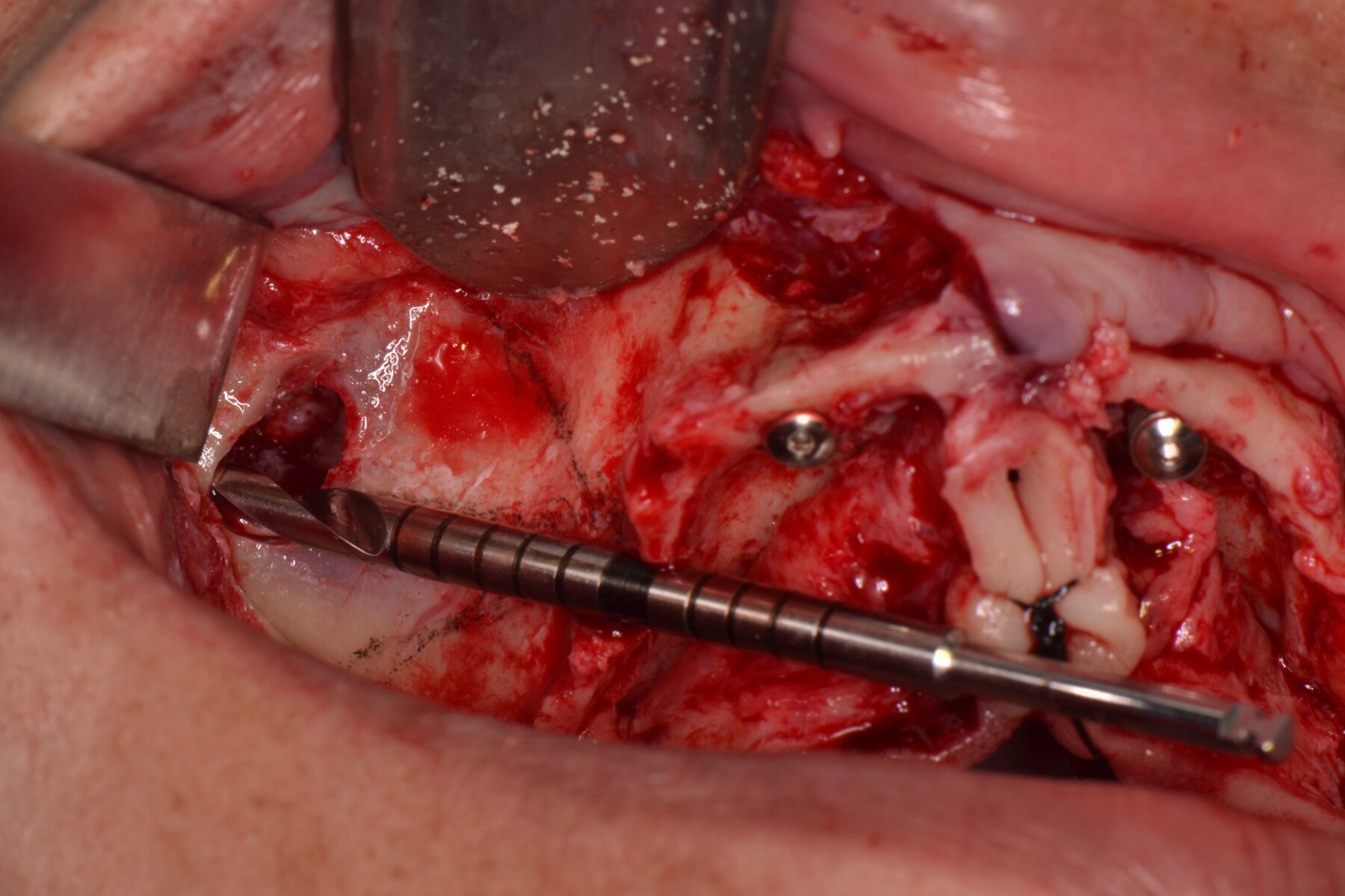 Control intraoperatorio del trayecto